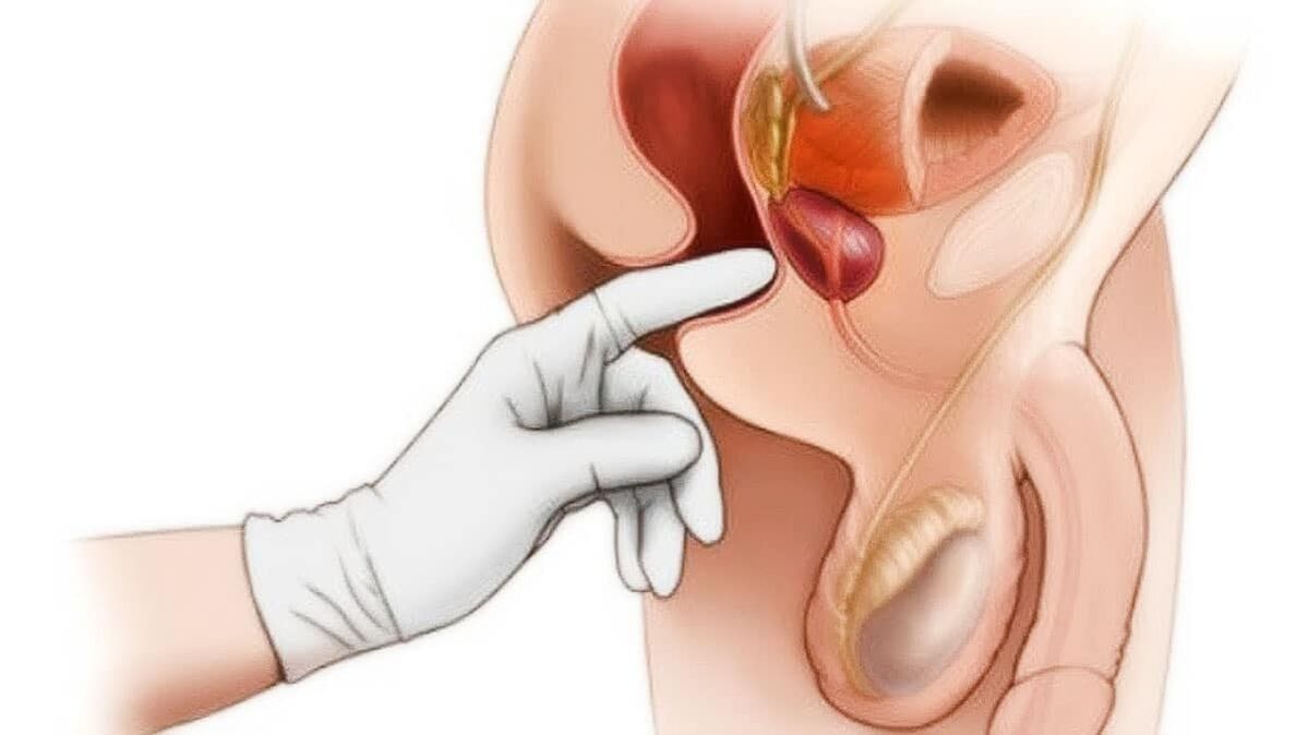 Diagnosi della prostatite e suo trattamento con il dispositivo