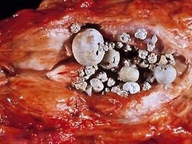 Calcoli nella prostata nella prostatite calcifica