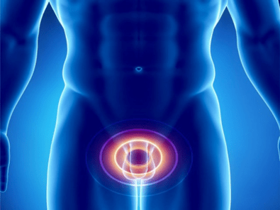 Prostatite – infiammazione della prostata negli uomini