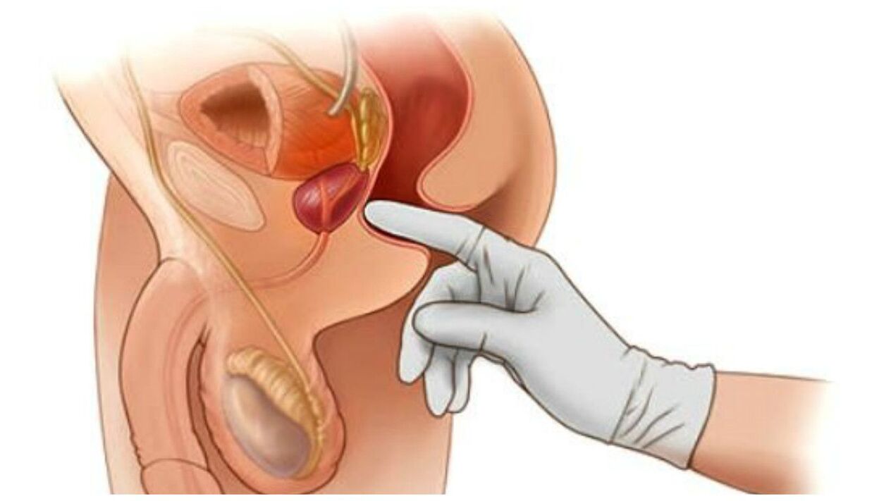 Massaggio alla prostata
