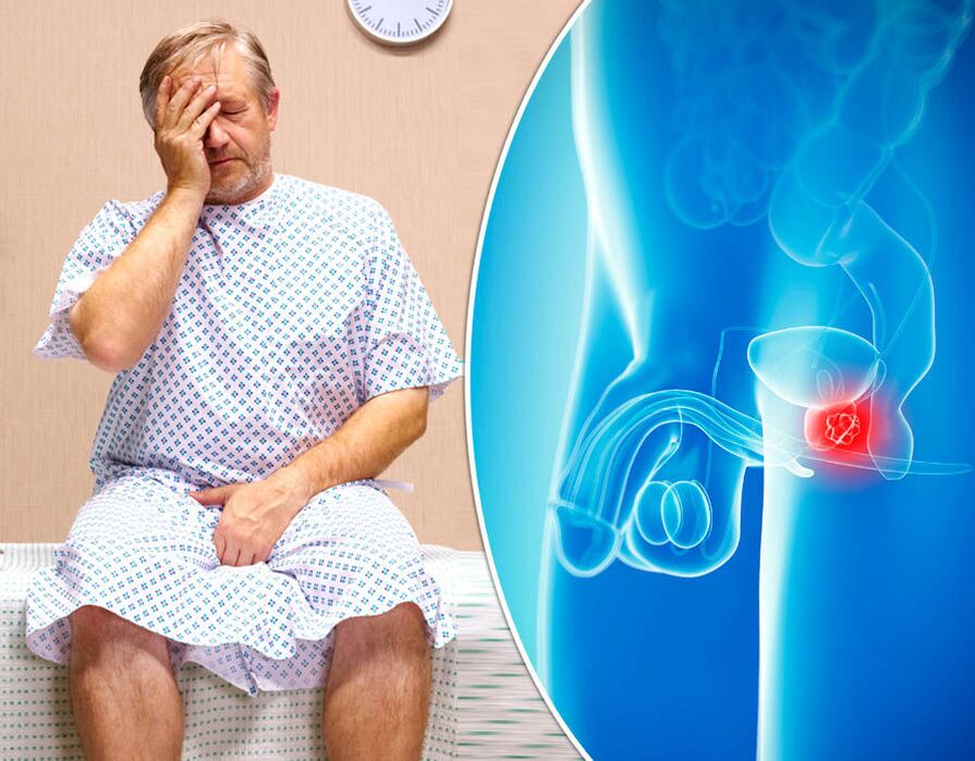 Una malattia viene diagnosticata in un uomo con prostatite